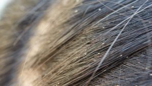 Does Drugstore Lice Shampoo Really Kill the Eggs?