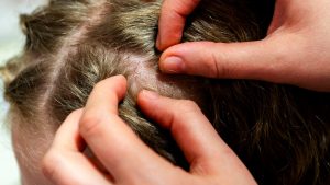 Does Dawn Dish Soap Really Kill Lice or Just Stun Them? featured image