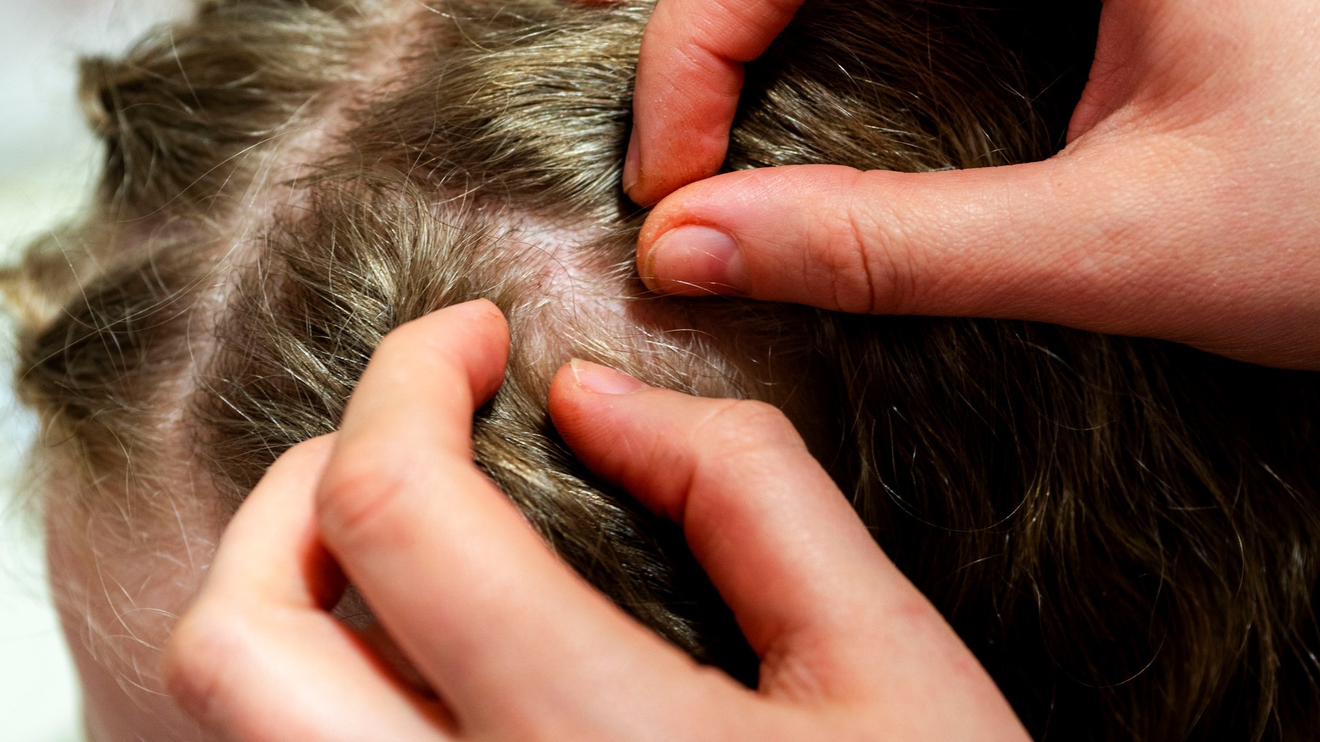 Does Dawn Dish Soap Really Kill Lice or Just Stun Them? featured image