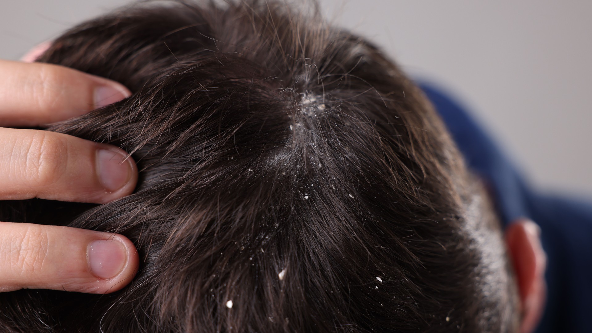 Upgraded: Super Lice: What They Are and How to Treat Them