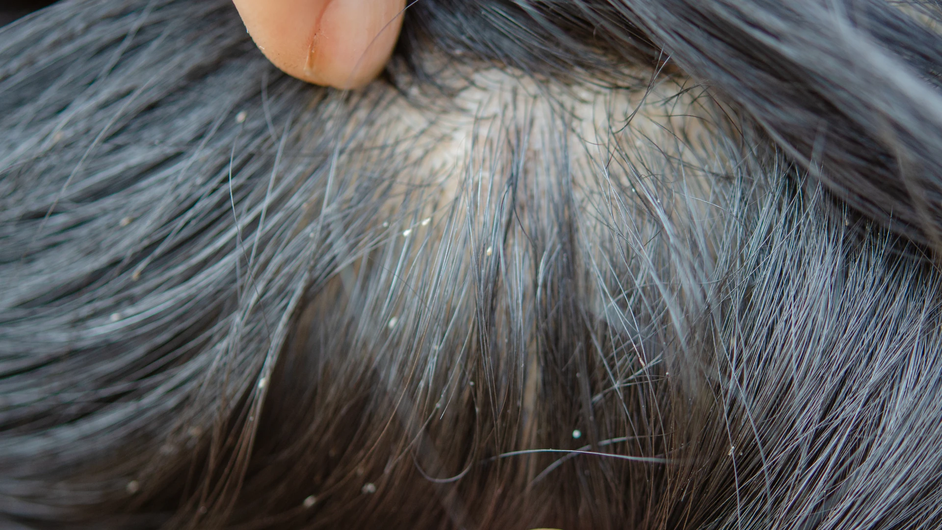 Close-up of dark hair parted by a fingertip, with small white lice eggs clinging to the strands